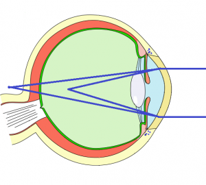 Astigmatism