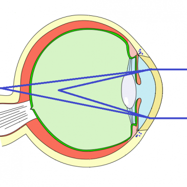 What is Astigmatism?