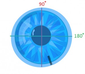 Misaligned Contact Lens