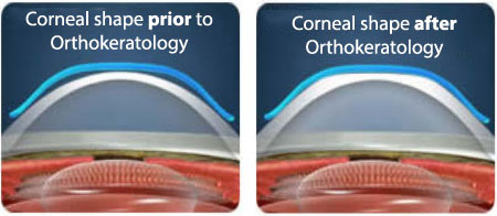 Ortho K Contacts - Corneal Shape