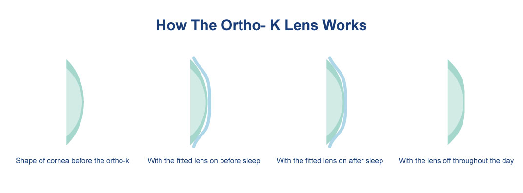 Are Ortho K Contacts For You? Contacts Advice