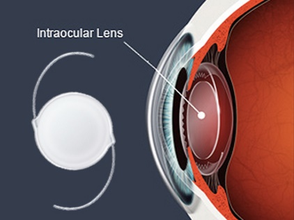 Reading Contact Lens Prescription - Intraocular lens