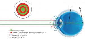 MiSight Contact Lenses: New Treatment For Myopia Control - Contacts Advice