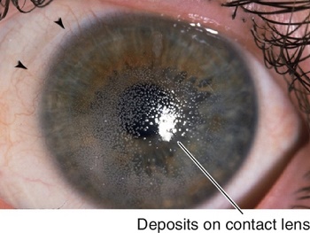 contact lens irritation - contact lens deposits