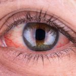 Top 15 Causes of Contact Lens Irritation