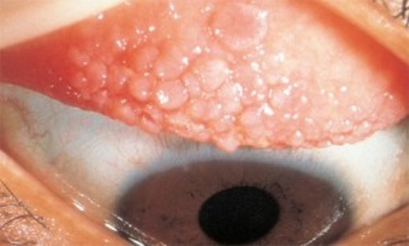 contact lens irritation - giant papillary conjunctivitis