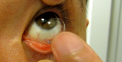 putting contact lenses into the eyes