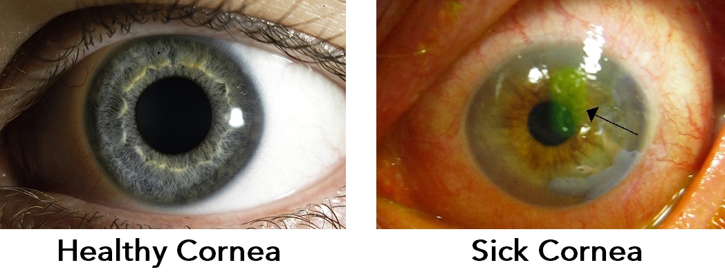 Healthy Cornea VS Sick Cornea