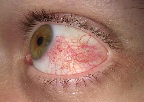 Red eye - Conjunctivitis