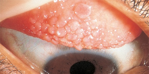 giant papillary conjunctivitis