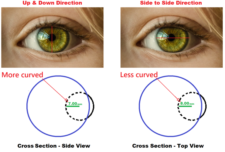 can-lasik-fix-astigmatism-contacts-advice